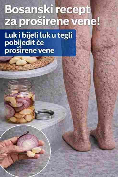 Recite zbogom proširenim venama na prirodan način: jednostavni kućni postupci s bijelim lukom, lukom i maslinovim uljem
