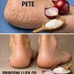 Boli Vas pete? Isprobajte ovih 5 kućnih lijekova koji zaista pomažu