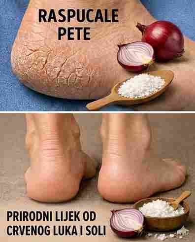 Boli Vas pete? Isprobajte ovih 5 kućnih lijekova koji zaista pomažu