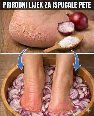 Suhe i bolne pete? Isprobajte ovih 5 kućnih lijekova koji stvarno pomažu