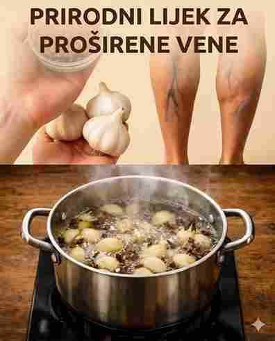 Zbogom proširenim venama! 🌿 Češnjak i klinčić – domaći lijek koji iznenađuje sve!